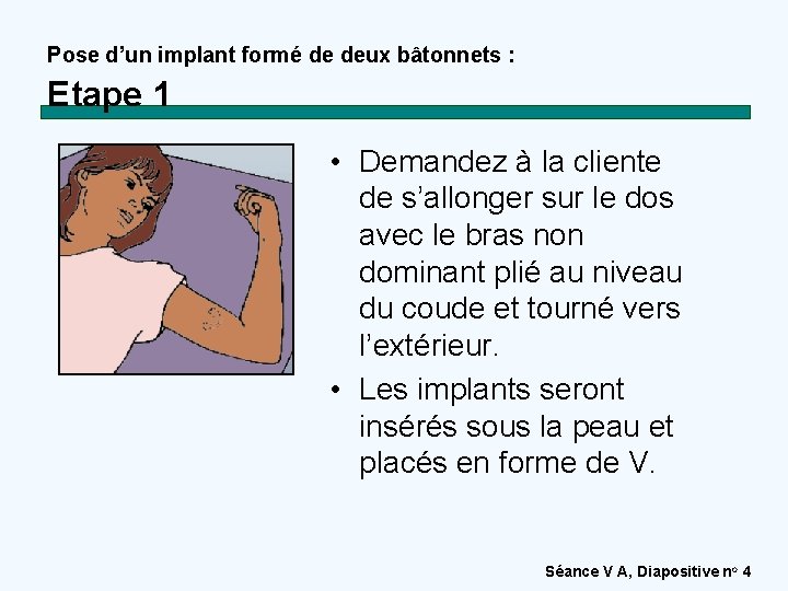 Pose d’un implant formé de deux bâtonnets : Etape 1 • Demandez à la