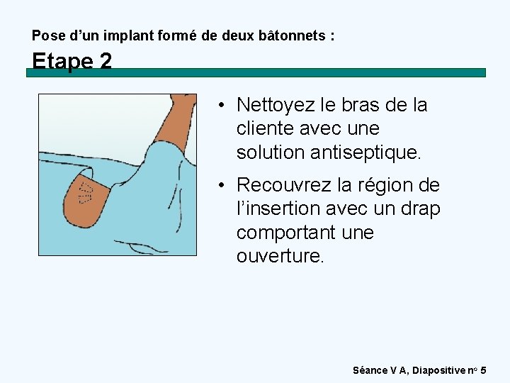 Pose d’un implant formé de deux bâtonnets : Etape 2 • Nettoyez le bras