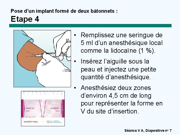 Pose d’un implant formé de deux bâtonnets : Etape 4 • Remplissez une seringue