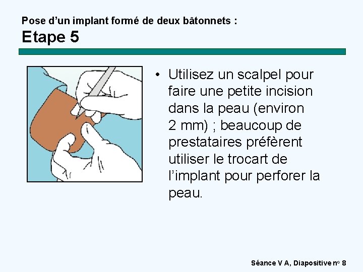 Pose d’un implant formé de deux bâtonnets : Etape 5 • Utilisez un scalpel