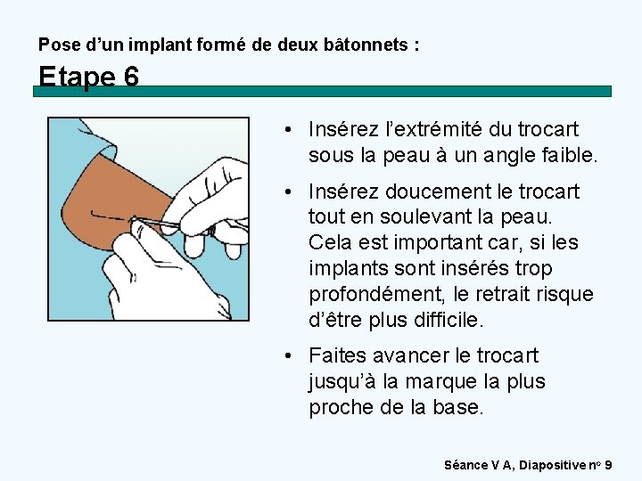 Pose d’un implant formé de deux bâtonnets : Etape 6 • Insérez l’extrémité du