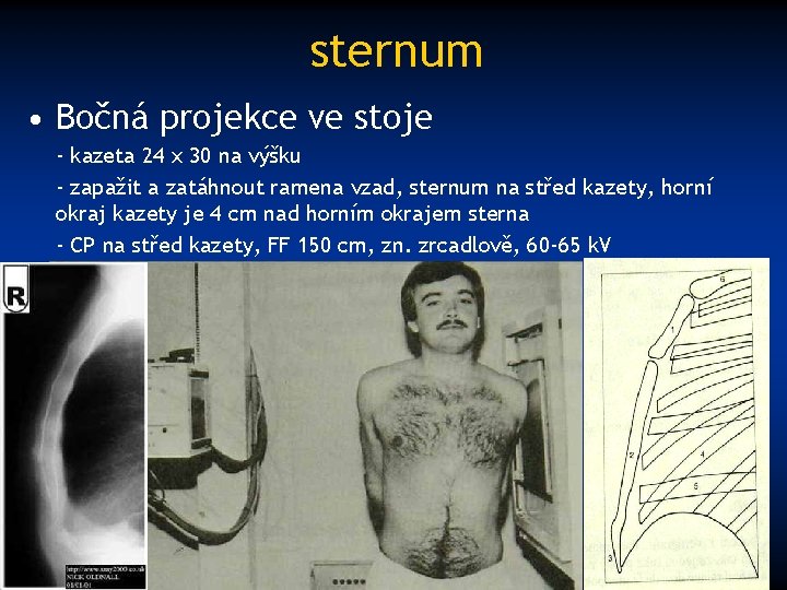 sternum • Bočná projekce ve stoje - kazeta 24 x 30 na výšku -