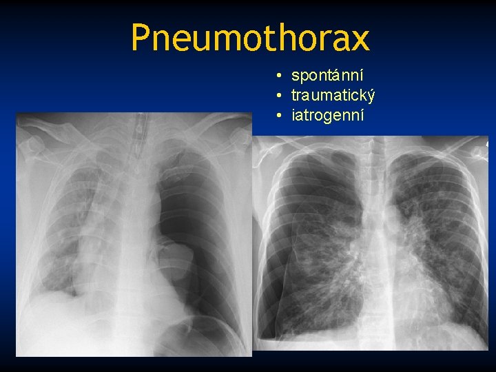 Pneumothorax • spontánní • traumatický • iatrogenní 