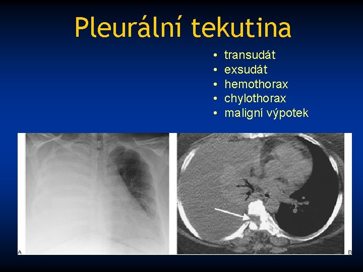 Pleurální tekutina • • • transudát exsudát hemothorax chylothorax maligní výpotek 