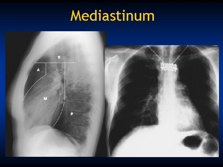 Mediastinum 