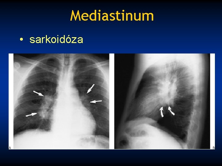 Mediastinum • sarkoidóza 