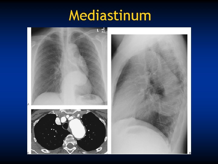 Mediastinum 