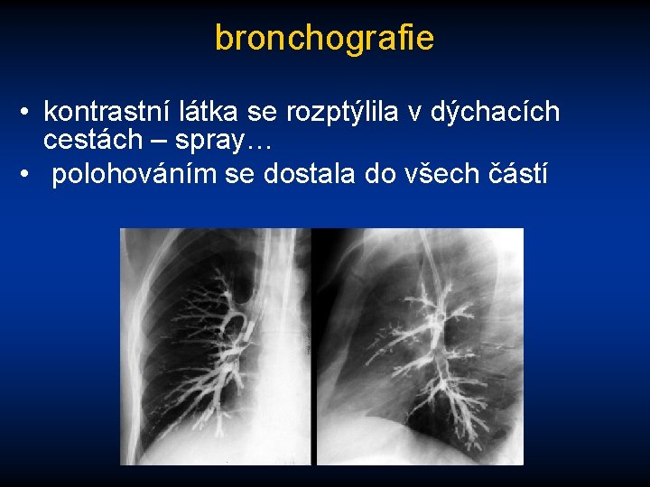 bronchografie • kontrastní látka se rozptýlila v dýchacích cestách – spray… • polohováním se