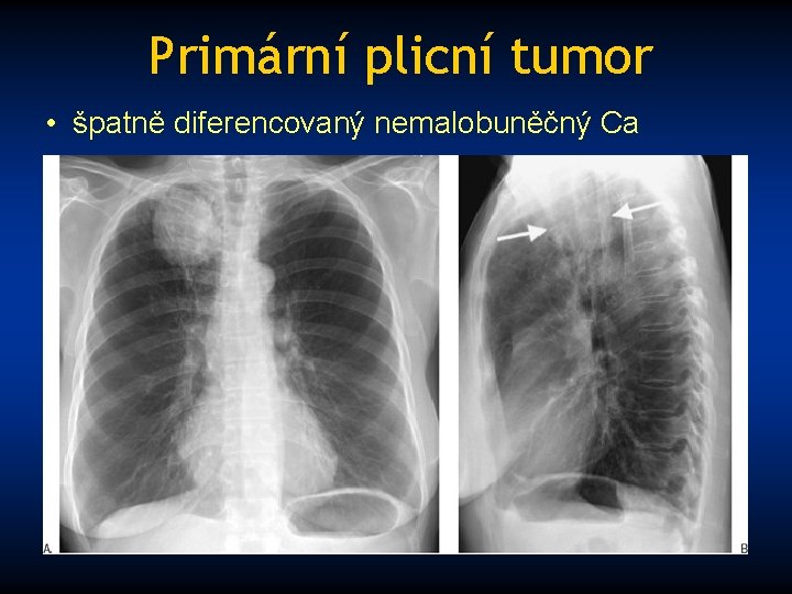 Primární plicní tumor • špatně diferencovaný nemalobuněčný Ca 