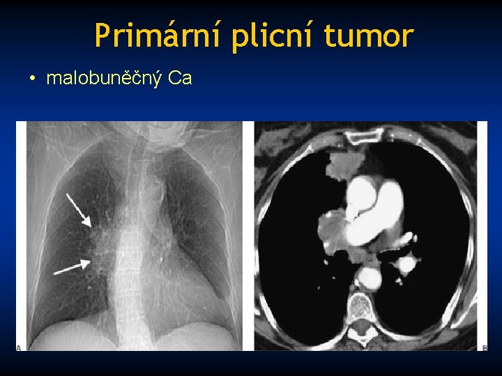 Primární plicní tumor • malobuněčný Ca 