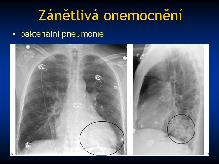 Zánětlivá onemocnění • bakteriální pneumonie 