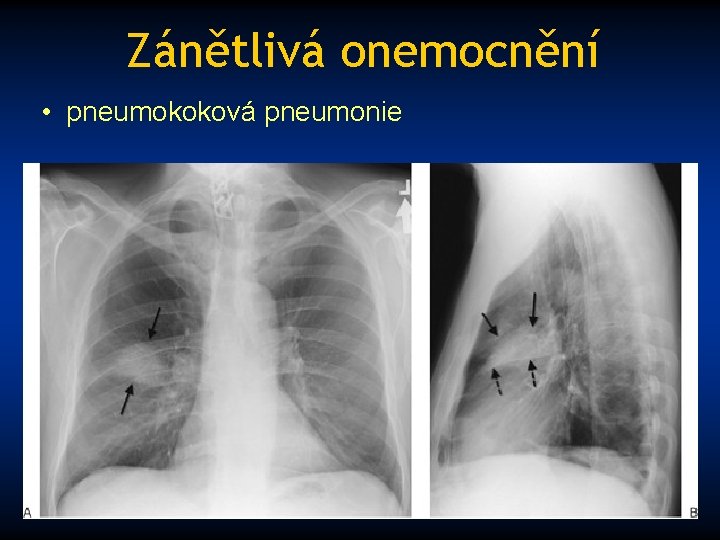 Zánětlivá onemocnění • pneumokoková pneumonie 