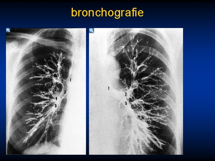 bronchografie 
