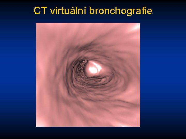 CT virtuální bronchografie 