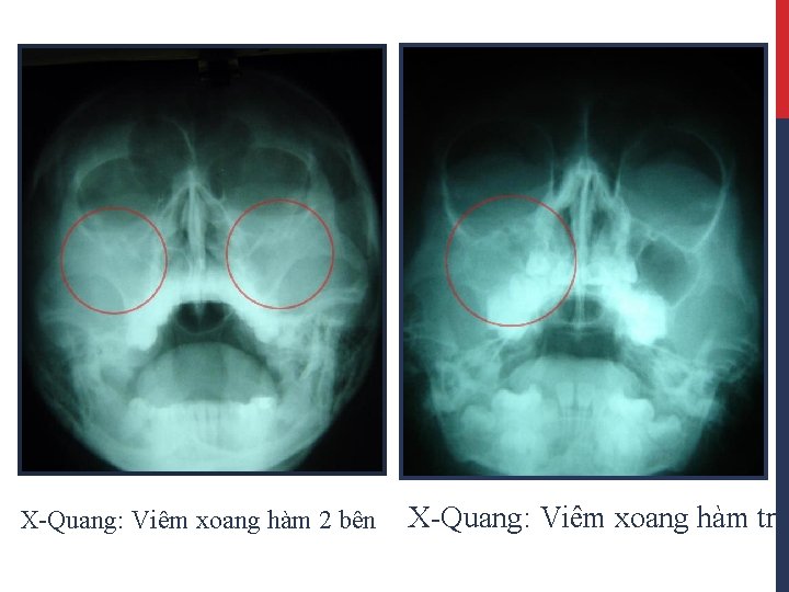 X-Quang: Viêm xoang hàm 2 bên X-Quang: Viêm xoang hàm trá 