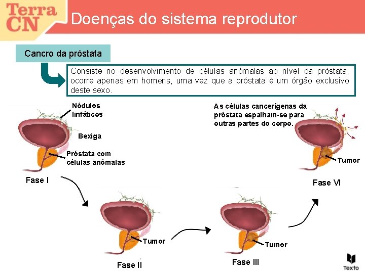 Doenças do sistema reprodutor Cancro da próstata Consiste no desenvolvimento de células anómalas ao