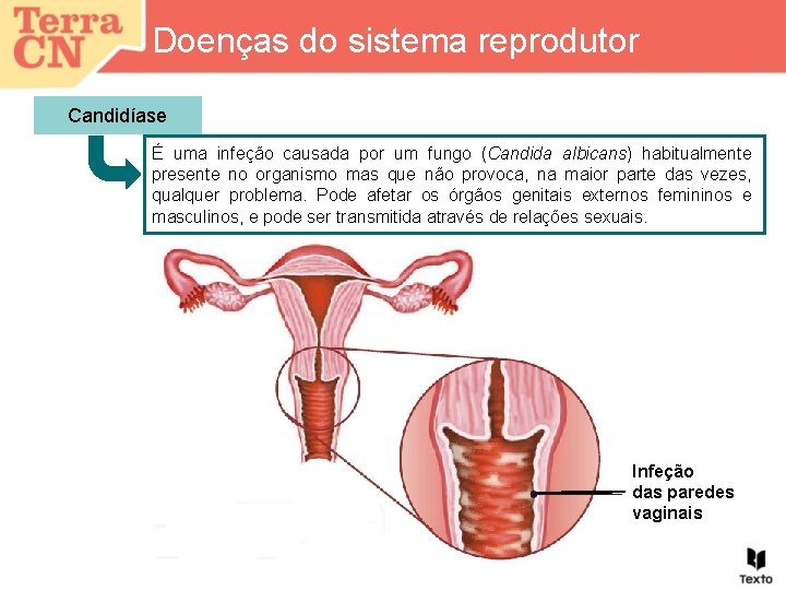 Doenças do sistema reprodutor Candidíase É uma infeção causada por um fungo (Candida albicans)