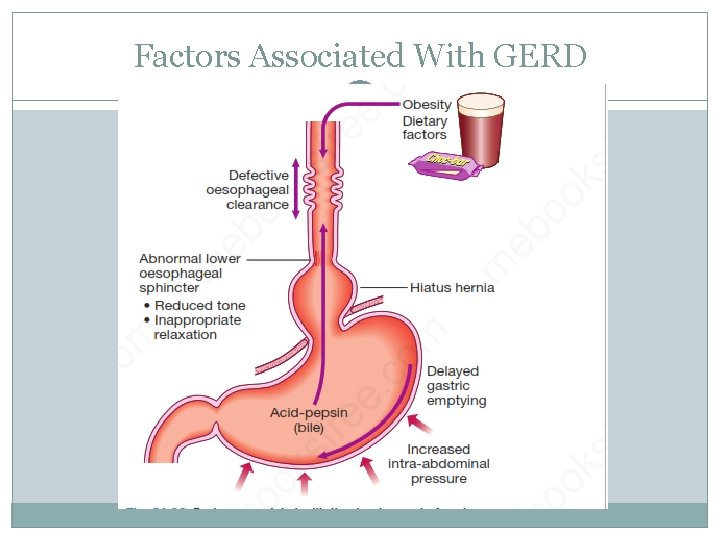 Factors Associated With GERD 