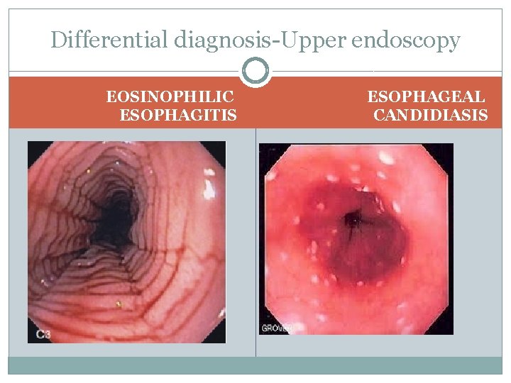 Differential diagnosis Upper endoscopy EOSINOPHILIC ESOPHAGITIS ESOPHAGEAL CANDIDIASIS 