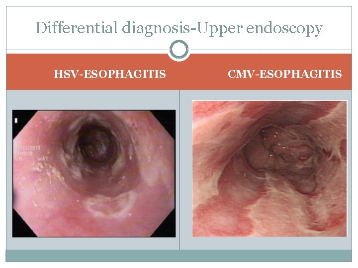 Differential diagnosis Upper endoscopy HSV-ESOPHAGITIS CMV-ESOPHAGITIS 