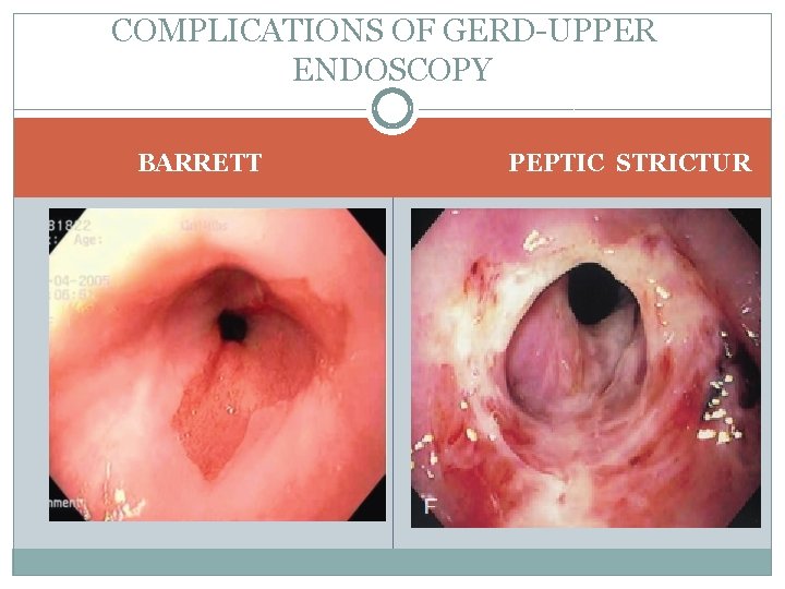 COMPLICATIONS OF GERD UPPER ENDOSCOPY BARRETT PEPTIC STRICTUR 