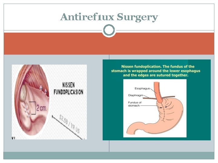 Antiref 1 ux Surgery 