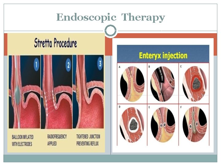 Endoscopic Therapy 