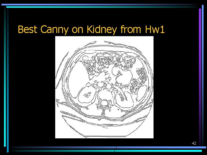 Best Canny on Kidney from Hw 1 42 