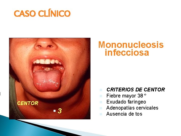 CASO CLÍNICO Mononucleosis infecciosa n n n CENTOR § 3 n n CRITERIOS DE