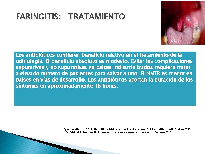 FARINGITIS: TRATAMIENTO Los antibióticos confieren beneficio relativo en el tratamiento de la odinofagia. El