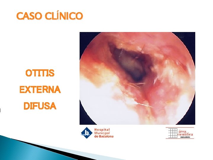 CASO CLÍNICO OTITIS EXTERNA DIFUSA 