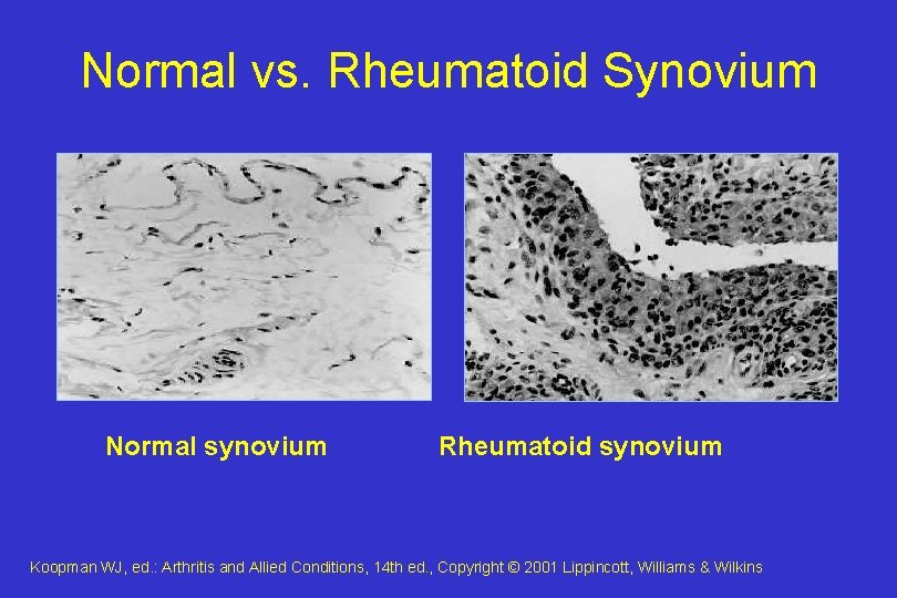 Normal vs. Rheumatoid Synovium Normal synovium Rheumatoid synovium Koopman WJ, ed. : Arthritis and