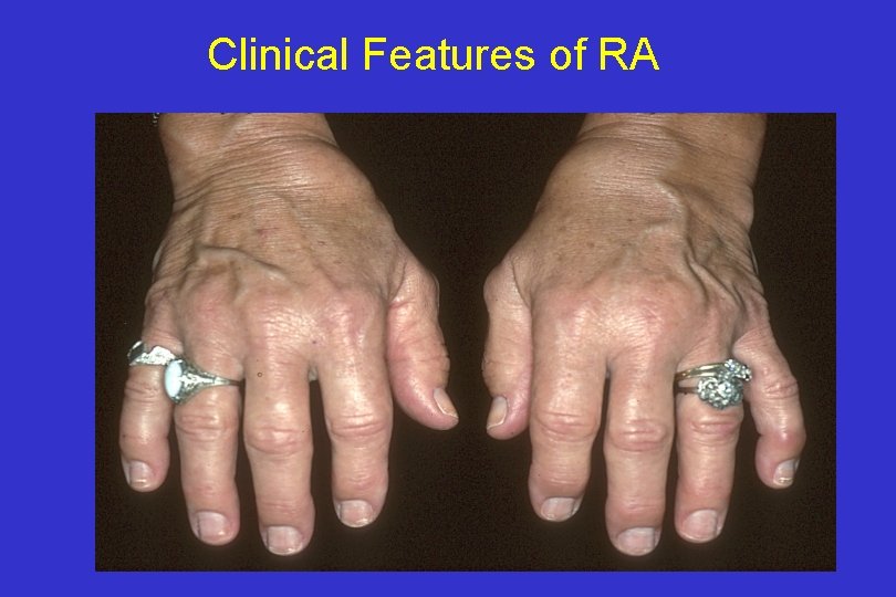 Clinical Features of RA 