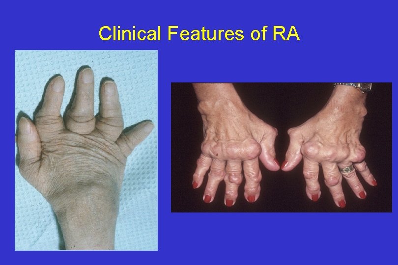 Clinical Features of RA 