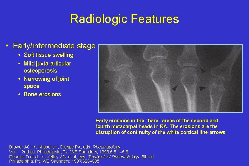 Radiologic Features • Early/intermediate stage • Soft tissue swelling • Mild juxta-articular osteoporosis •