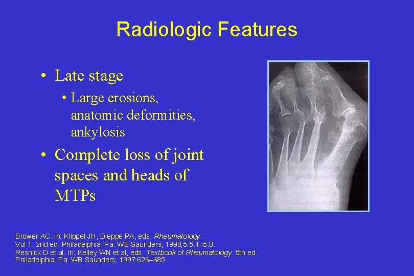Radiologic Features • Late stage • Large erosions, anatomic deformities, ankylosis • Complete loss