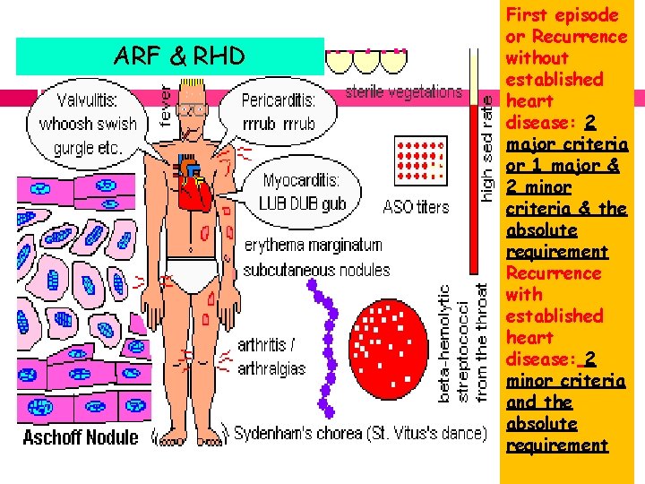ARF & RHD First episode or Recurrence without established heart disease: 2 major criteria