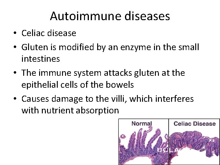 Autoimmune diseases • Celiac disease • Gluten is modified by an enzyme in the