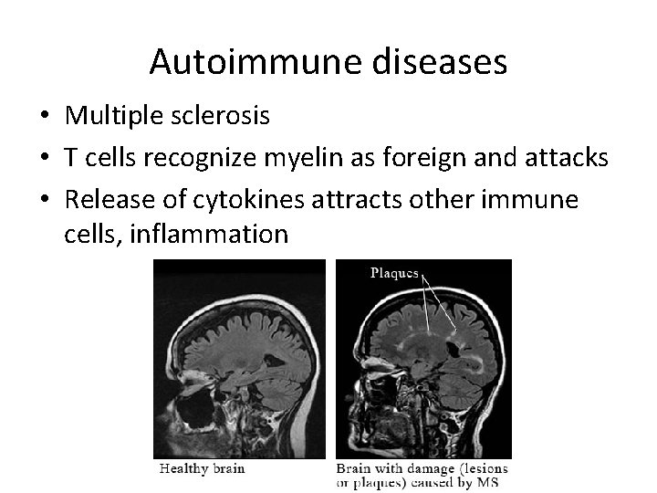 Autoimmune diseases • Multiple sclerosis • T cells recognize myelin as foreign and attacks