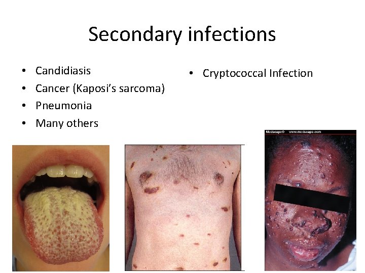 Secondary infections • • Candidiasis Cancer (Kaposi’s sarcoma) Pneumonia Many others • Cryptococcal Infection