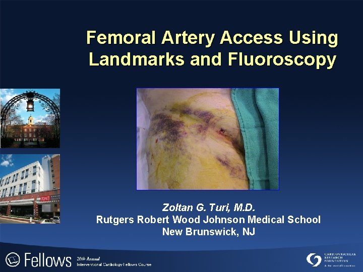 Femoral Artery Access Using Landmarks and Fluoroscopy Zoltan G. Turi, M. D. Rutgers Robert