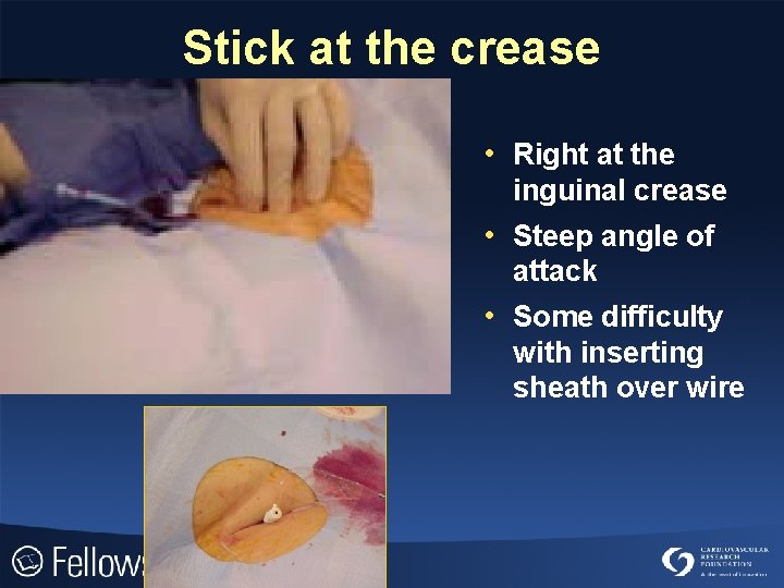 Stick at the crease • Right at the inguinal crease • Steep angle of