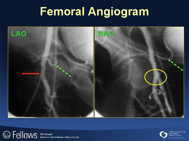 Femoral Angiogram LAO RAO 