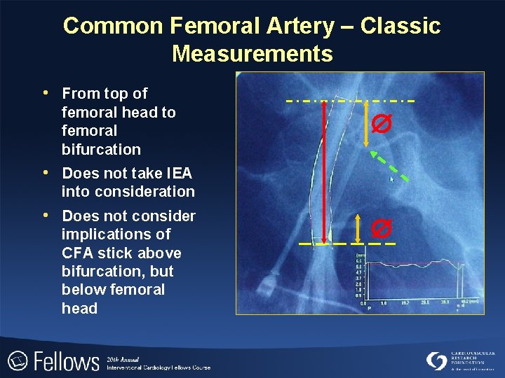 Common Femoral Artery – Classic Measurements • From top of femoral head to femoral
