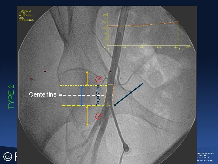 TYPE 2 Centerline Target Zone 