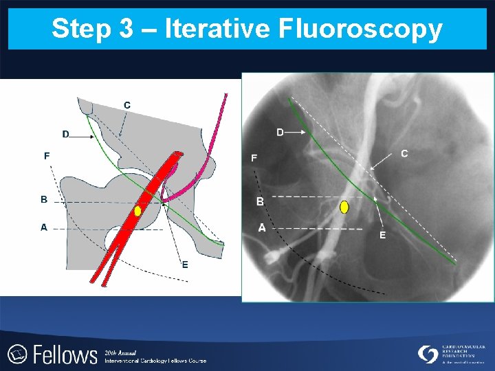 Step 3 – Iterative Fluoroscopy 