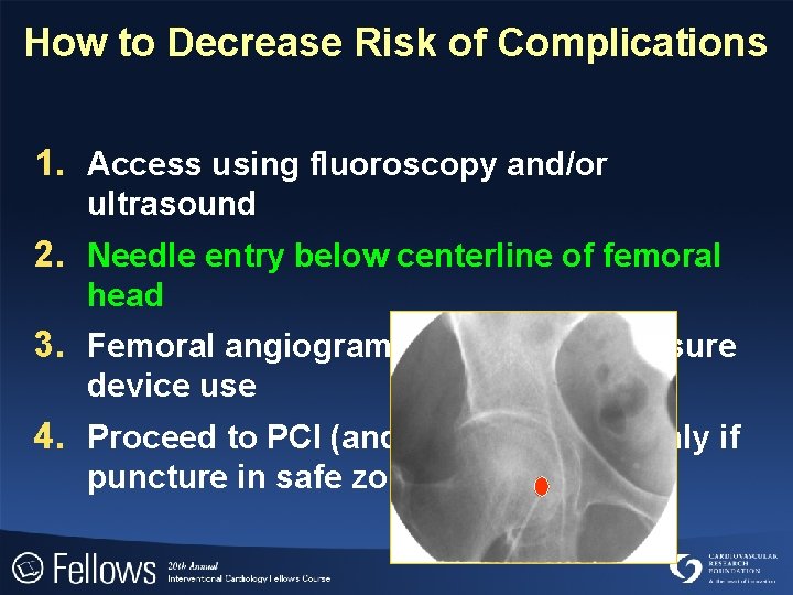 How to Decrease Risk of Complications 1. Access using fluoroscopy and/or ultrasound 2. Needle