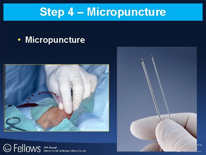 Step 4 – Micropuncture • Micropuncture 