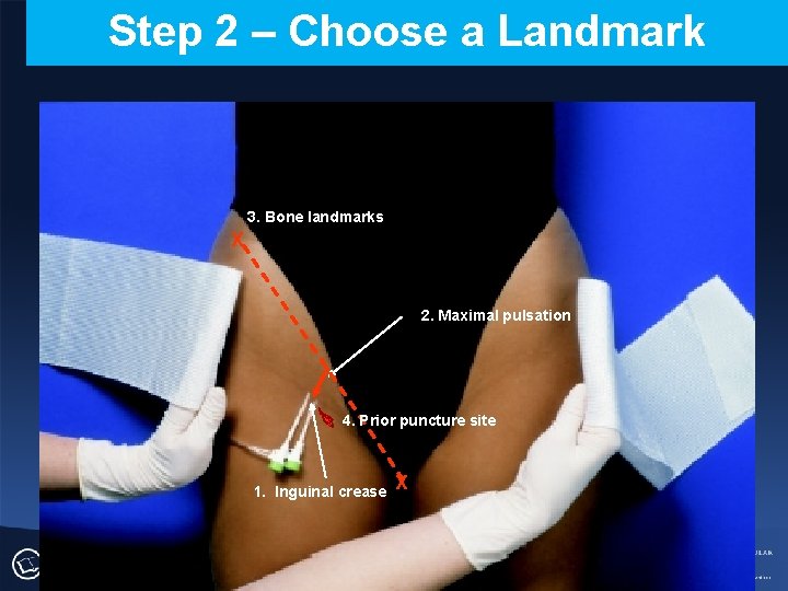 Step 2 – Choose a Landmark 3. Bone landmarks X 2. Maximal pulsation 4.