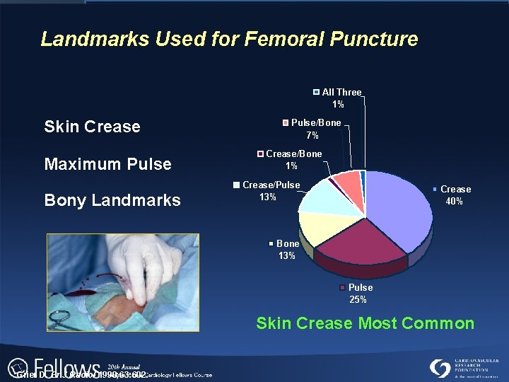 Landmarks Used for Femoral Puncture All Three 1% Skin Crease Maximum Pulse Bony Landmarks